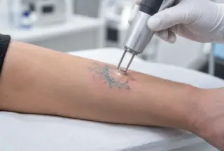 Gros plan réaliste d’un laser de détatouage traité sur un tatouage multicolore de l’avant-bras dans une clinique.